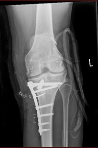 close knee x ray (1)