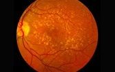 Age_related _macular_degeneration